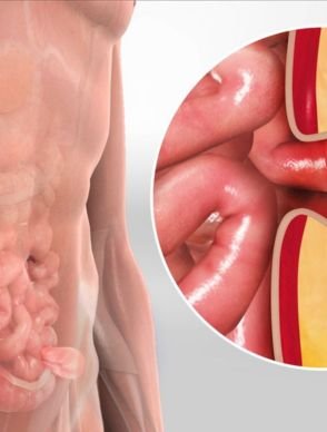 Hernia Repair Surgery